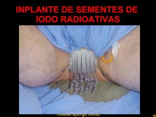 INPLANTE DE SEMENTES DE  IODO RADIOATIVAS Professor  Rodrigo Penna 