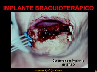 IMPLANTE BRAQUIOTERÁPICO Professor  Rodrigo Penna  www.fisicanovestibular.com.br   