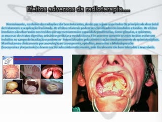 Efeitos adversos da radioterapia....       Normalmente , os efeitos das radiações são bem tolerantes, desde que sejam respeitados Os princípios de dose total de tratamento e a aplicação fracionada. Os efeitos colaterais podem ser classificados em imediatos e tardios. Os efeitos imediatos são observados nos tecidos que apresentam maior capacidade proliferativa, Como gônadas, a epiderme, as mucosas dos tratos digestivo, urinário e genital,e a medula óssea. Eles ocorrem somente se estes tecidos estiveram incluídos no campo de irradiação e podem ser  Potencializados pela administração simultaneamente de quimioterápicos. Manifestam-se clinicamente por anovolução ou azoospermia, epitelites, mucosites e Mielodepressão (leocopenia e plaquetonia) e devem ser tratados sintomaticamente, pois Geralmente são bem tolerados e reversíveis.