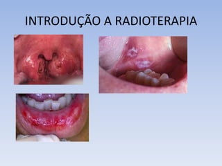 INTRODUÇÃO A RADIOTERAPIA
 