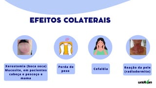 Xerostomia (boca seca)
Mucosite, em pacientes
cabeça e pescoço e
mama
Perda de
peso
Reação da pele
(radiodermite)
Cefaléia
EFEITOS COLATERAIS
 