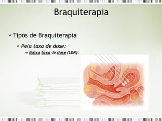 Braquiterapia 
Tipos de Braquiterapia 
PPeellaa ttaaxxaa ddee ddoossee:: 
BBaaiixxaa ttaaxxaa de ddoossee ((LLDDRR)): 
 