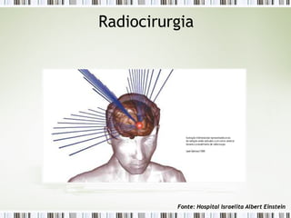 Radiocirurgia 
Fonte: Hospital Israelita AAllbbeerrtt EEiinnsstteeiinn 
 