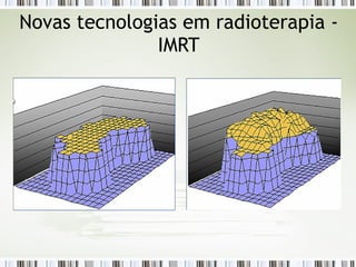 Novas tecnologias em radioterapia - 
IMRT 
 