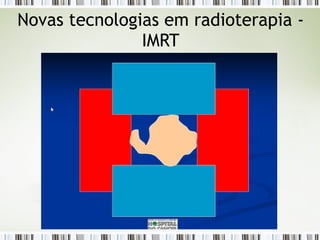 Novas tecnologias em radioterapia - 
IMRT 
 