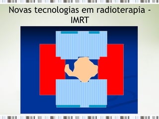 Novas tecnologias em radioterapia - 
IMRT 
 