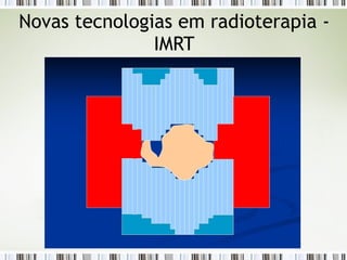 Novas tecnologias em radioterapia - 
IMRT 
 