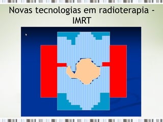 Novas tecnologias em radioterapia - 
IMRT 
 