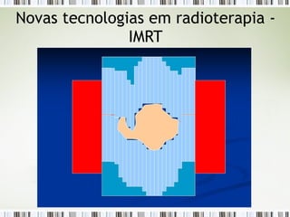 Novas tecnologias em radioterapia - 
IMRT 
 