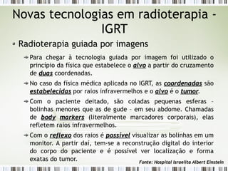 Novas tecnologias em radioterapia - 
IGRT 
Radioterapia guiada por imagens 
Para chegar à tecnologia guiada por imagem foi utilizado o 
princípio da física que estabelece o aallvvoo a partir do cruzamento 
de dduuaass coordenadas. 
No caso da física médica aplicada no IGRT, as ccoooorrddeennaaddaass são 
eessttaabbeelleecciiddaass por raios infravermelhos e o aallvvoo é o ttuummoorr. 
Com o paciente deitado, são coladas pequenas esferas – 
bolinhas menores que as de gude – em seu abdome. Chamadas 
de bbooddyy mmaarrkkeerrss (literalmente marcadores corporais), elas 
refletem raios infravermelhos. 
Com o rreefflleexxoo dos raios é ppoossssíívveell visualizar as bolinhas em um 
monitor. A partir daí, tem-se a reconstrução digital do interior 
do corpo do paciente e é possível ver localização e forma 
exatas do tumor. FFoonnttee:: HHoossppiittaall IIssrraaeelliittaa AAllbbeerrtt EEiinnsstteeiinn 
 