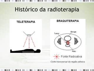 Histórico da radioterapia 
 