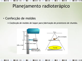 Planejamento radioterápico 
Confecção de moldes 
Confecção de moldes de isopor para fabricação de protetores ddee cchhuummbboo.. 
 