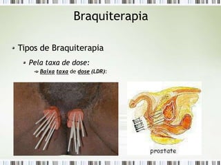 Braquiterapia
Tipos de Braquiterapia
Pela taxa de dose:
Baixa taxa de dose (LDR):
 
