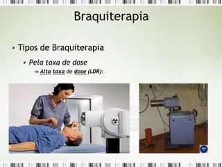 Braquiterapia
Tipos de Braquiterapia
Pela taxa de dose
Alta taxa de dose (LDR):
 