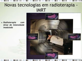 Novas tecnologias em radioterapia -
IMRT
Radioterapia com
feixe de intensidade
modulada
 
