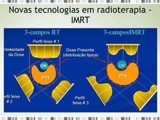 Novas tecnologias em radioterapia -
IMRT
 