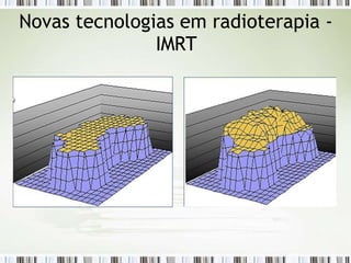 Novas tecnologias em radioterapia -
IMRT
 