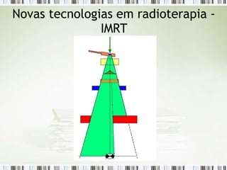 Novas tecnologias em radioterapia -
IMRT
 
