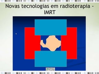 Novas tecnologias em radioterapia -
IMRT
 
