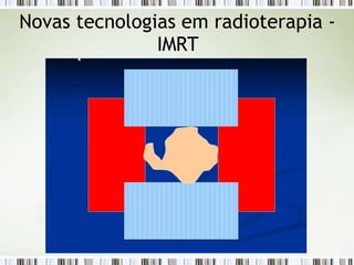 Novas tecnologias em radioterapia -
IMRT
 