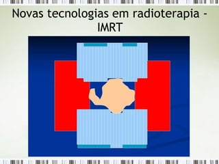 Novas tecnologias em radioterapia -
IMRT
 