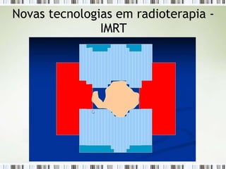 Novas tecnologias em radioterapia -
IMRT
 