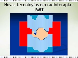 Novas tecnologias em radioterapia -
IMRT
 