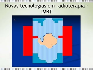 Novas tecnologias em radioterapia -
IMRT
 