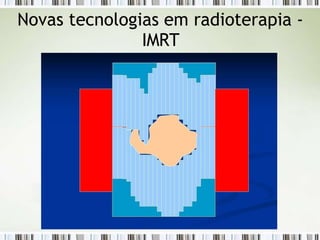 Novas tecnologias em radioterapia -
IMRT
 
