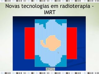Novas tecnologias em radioterapia -
IMRT
 