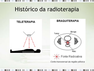 Histórico da radioterapia
 