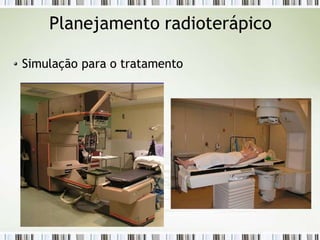 Planejamento radioterápico
Simulação para o tratamento
 