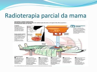 Radioterapia parcial da mama
 