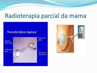 Radioterapia parcial da mama
 