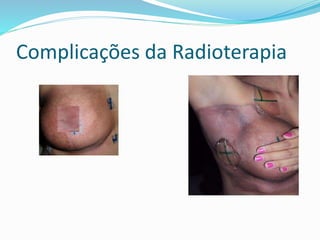 Complicações da Radioterapia
 
