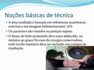Noções básicas de técnica
 A área irradiada é baseada em referências anatômicas
externas e em imagens bidimensionais( 2D).
 Os pacientes são tratados na posição supina.
 O braço do lado acometido deve estar abduzido, no
mínimo 90 graus.No caso de cirurgia conservadora,
todo tecido mamário deve ser incluído nos campos de
irradiação.
 