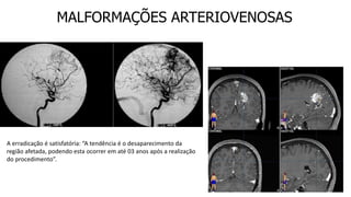 MALFORMAÇÕES ARTERIOVENOSAS
A erradicação é satisfatória: “A tendência é o desaparecimento da
região afetada, podendo esta ocorrer em até 03 anos após a realização
do procedimento”.
 