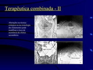 Terapêutica combinada - II Alterações na técnica cirúrgica ou na cronologia dos tratamentos pode modificar o risco de ocorrência de efeitos secundários 