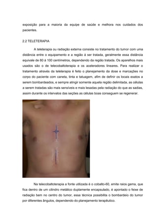 exposição para a maioria da equipe de saúde e melhora nos cuidados dos
pacientes.
2.2 TELETERAPIA
A teleterapia ou radiação externa consiste no tratamento do tumor com uma
distância entre o equipamento e a região á ser tratada, geralmente essa distância
equivale de 80 á 100 centímetros, dependendo da região tratada. Os aparelhos mais
usados são o de telecobaltoterapia e os aceleradores lineares. Para realizar o
tratamento através da teleterapia é feito o planejamento da dose e marcações no
corpo do paciente com caneta, tinta e tatuagem, afim de definir os locais exatos a
serem bombardeados, e sempre atingir somente aquela região delimitada, as células
a serem tratadas são mais sensíveis e mais lesadas pela radiação do que as sadias,
assim durante os intervalos das seções as células boas conseguem se regenerar.
Na telecobaltoterapia a fonte utilizada é o cobalto-60, emite raios gama, que
fica dentro de um cilindro metálico duplamente encapsulado, é apontado o feixe de
radiação bem no centro do tumor, essa técnica possibilita o bombardeio do tumor
por diferentes ângulos, dependendo do planejamento terapêutico.
 
