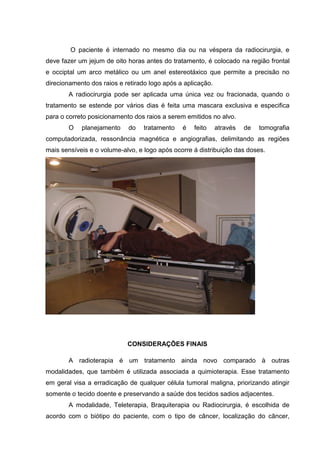 O paciente é internado no mesmo dia ou na véspera da radiocirurgia, e
deve fazer um jejum de oito horas antes do tratamento, é colocado na região frontal
e occiptal um arco metálico ou um anel estereotáxico que permite a precisão no
direcionamento dos raios e retirado logo após a aplicação.
A radiocirurgia pode ser aplicada uma única vez ou fracionada, quando o
tratamento se estende por vários dias é feita uma mascara exclusiva e especifica
para o correto posicionamento dos raios a serem emitidos no alvo.
O planejamento do tratamento é feito através de tomografia
computadorizada, ressonância magnética e angiografias, delimitando as regiões
mais sensíveis e o volume-alvo, e logo após ocorre á distribuição das doses.
CONSIDERAÇÕES FINAIS
A radioterapia é um tratamento ainda novo comparado à outras
modalidades, que também é utilizada associada a quimioterapia. Esse tratamento
em geral visa a erradicação de qualquer célula tumoral maligna, priorizando atingir
somente o tecido doente e preservando a saúde dos tecidos sadios adjacentes.
A modalidade, Teleterapia, Braquiterapia ou Radiocirurgia, é escolhida de
acordo com o biótipo do paciente, com o tipo de câncer, localização do câncer,
 