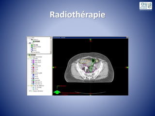 Radiothérapie
 