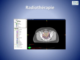 Radiothérapie
 
