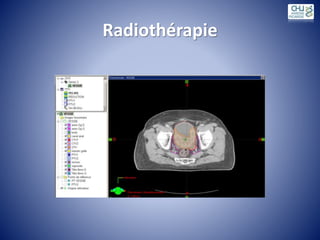 Radiothérapie
 