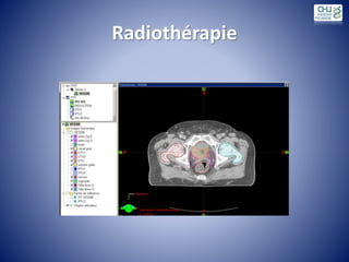 Radiothérapie
 