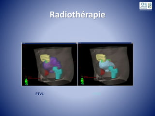 Radiothérapie
PTV1 PTV2
 