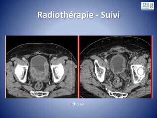 Radiothérapie - Suivi
 1 an
 