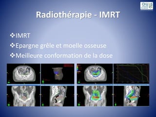 Radiothérapie - IMRT
IMRT
Epargne grêle et moelle osseuse
Meilleure conformation de la dose
 