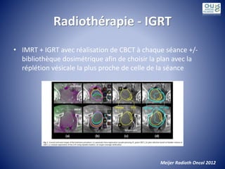 Radiothérapie - IGRT
• IMRT + IGRT avec réalisation de CBCT à chaque séance +/-
bibliothèque dosimétrique afin de choisir la plan avec la
réplétion vésicale la plus proche de celle de la séance
Meijer Radioth Oncol 2012
 