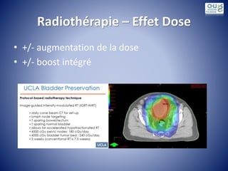 Radiothérapie – Effet Dose
• +/- augmentation de la dose
• +/- boost intégré
 