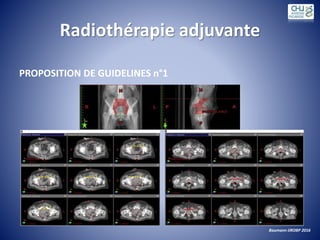 Radiothérapie adjuvante
PROPOSITION DE GUIDELINES n°1
Baumann IJROBP 2016
 